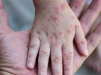 • As at Thursday, Ghana has recorded five cases of monkeypox