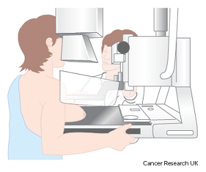 Screening for Breast Cancer