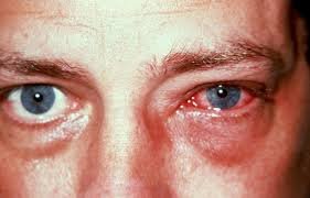 An appollo infected eye