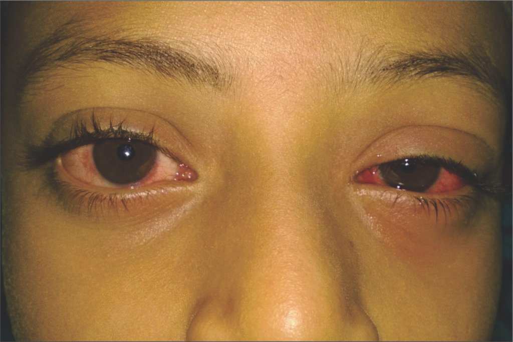 Both eyes infected with appollo