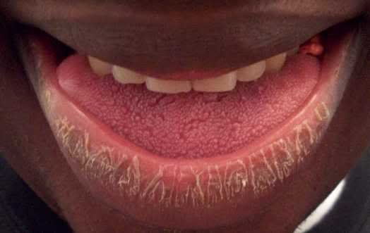 Harmattan can cause chapped lips
