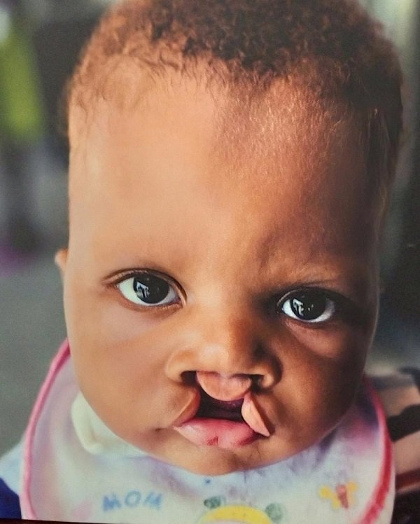 • A child with cleft palate
