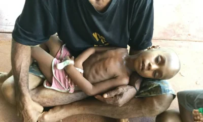 Malnutrition leads to death