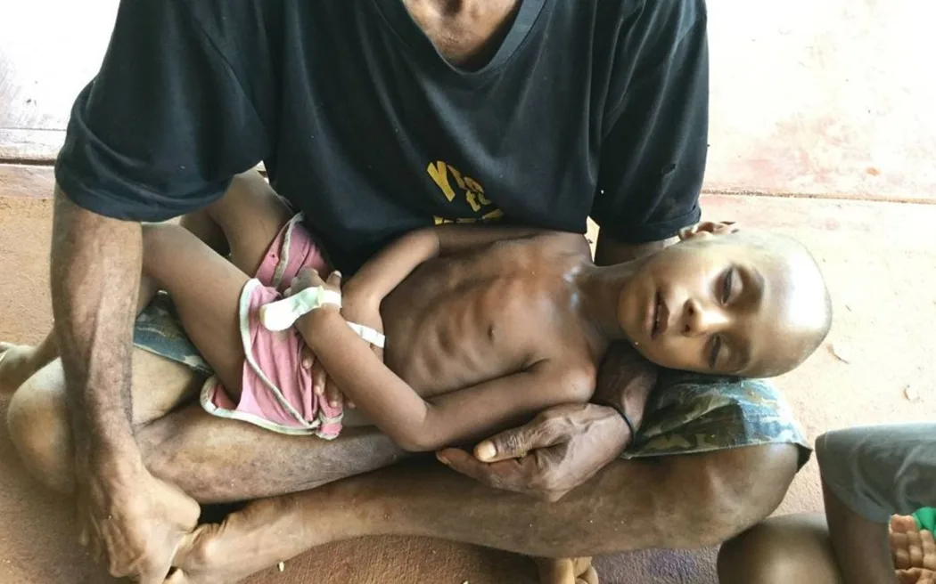 Malnutrition leads to death